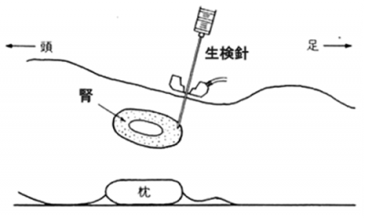 腎生検