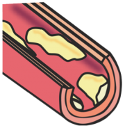 高血圧性腎硬化症